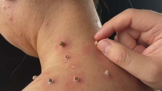 KIT ELIMINADOR DEFINITIVO DE VERRUGAS SIN DOLOR